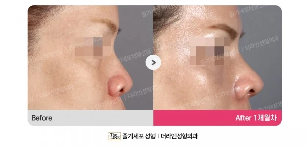 Alar Reduction before-and-after photo, before surgery - TheLINE Plastic Surgery