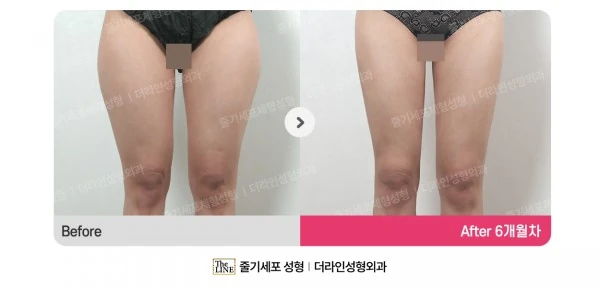 Thigh Liposuction before-and-after photo, before surgery - TheLINE Plastic Surgery