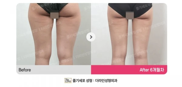 Thigh Liposuction before-and-after photo, before surgery - TheLINE Plastic Surgery
