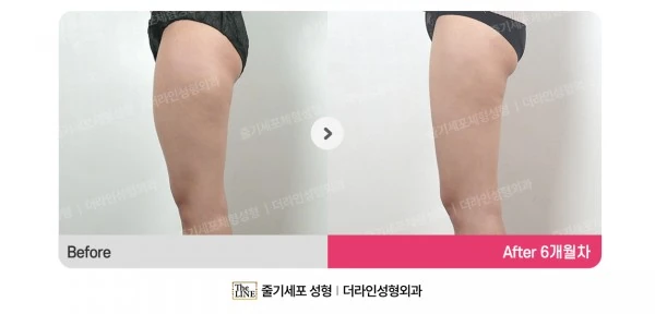Thigh Liposuction before-and-after photo, before surgery - TheLINE Plastic Surgery