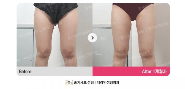 Thigh Liposuction before-and-after photo, before surgery - TheLINE Plastic Surgery