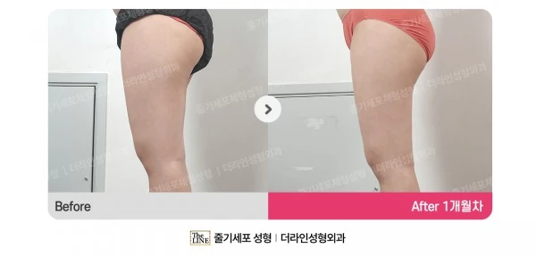 Thigh Liposuction before-and-after photo, before surgery - TheLINE Plastic Surgery