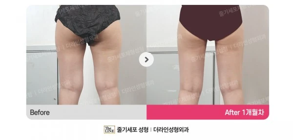 Thigh Liposuction before-and-after photo, before surgery - TheLINE Plastic Surgery