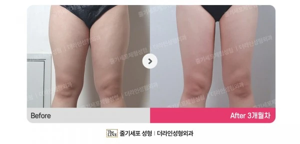 Thigh Liposuction before-and-after photo, before surgery - TheLINE Plastic Surgery
