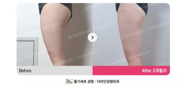 Thigh Liposuction before-and-after photo, before surgery - TheLINE Plastic Surgery
