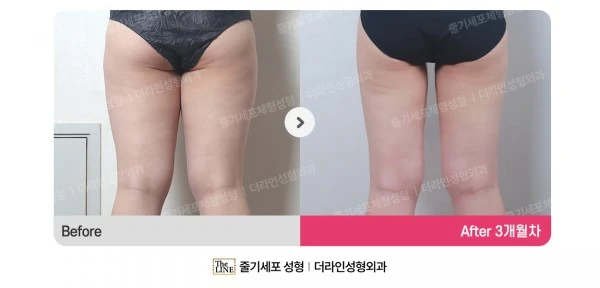 Thigh Liposuction before-and-after photo, before surgery - TheLINE Plastic Surgery