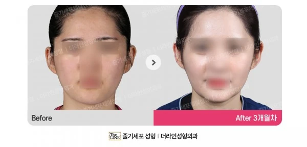 Power V Facial Contouring, before and after 3 months at Seoul Lipo Center