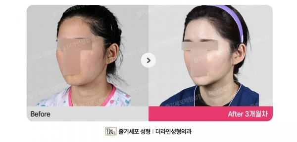 Power V Facial Contouring before-and-after photo, before surgery - TheLINE Plastic Surgery