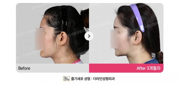 Power V Facial Contouring before-and-after photo, before surgery - TheLINE Plastic Surgery