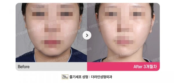 Power V Facial Contouring, before and after 3 months at Seoul Lipo Center