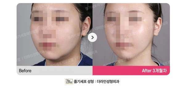 Power V Facial Contouring before-and-after photo, before surgery - TheLINE Plastic Surgery