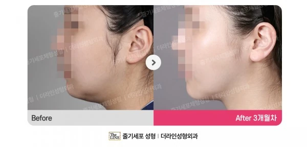 Power V Facial Contouring before-and-after photo, before surgery - TheLINE Plastic Surgery