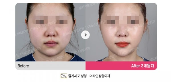 Power V Facial Contouring, before and after 3 months at Seoul Lipo Center