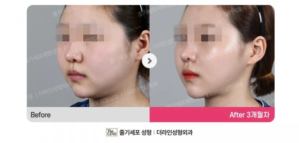 Power V Facial Contouring before-and-after photo, before surgery - TheLINE Plastic Surgery