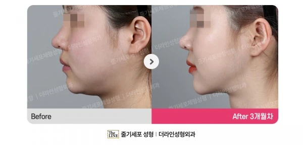 Power V Facial Contouring before-and-after photo, before surgery - TheLINE Plastic Surgery