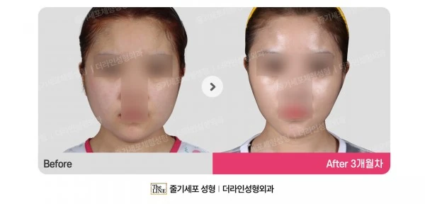 Power V Facial Contouring, before and after 3 months at Seoul Lipo Center