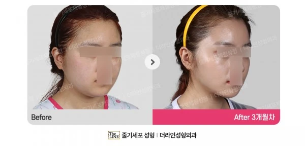 Power V Facial Contouring before-and-after photo, before surgery - TheLINE Plastic Surgery