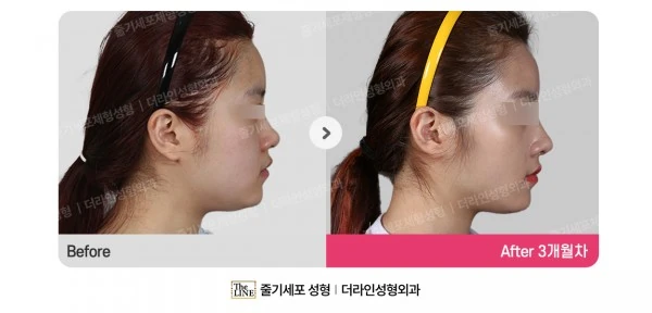 Power V Facial Contouring before-and-after photo, before surgery - TheLINE Plastic Surgery