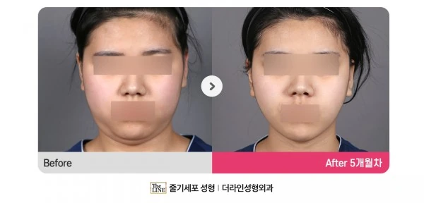 Power V Facial Contouring, before and after 5 months at Seoul Lipo Center