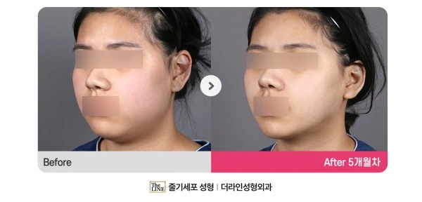 Power V Facial Contouring before-and-after photo, before surgery - TheLINE Plastic Surgery