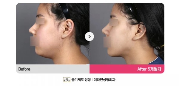 Power V Facial Contouring before-and-after photo, before surgery - TheLINE Plastic Surgery