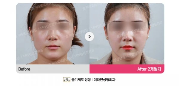 Power V Facial Contouring, before and after 2 months at Seoul Lipo Center