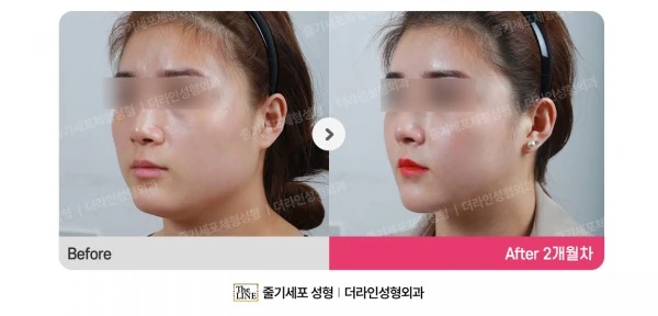 Power V Facial Contouring before-and-after photo, before surgery - TheLINE Plastic Surgery