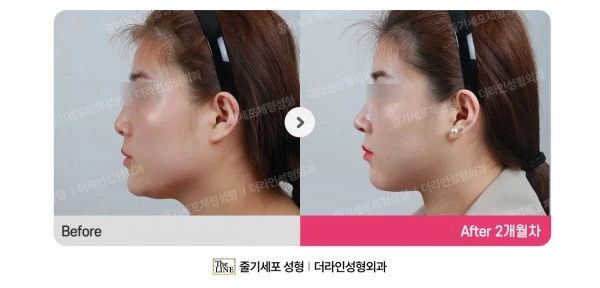 Power V Facial Contouring before-and-after photo, before surgery - TheLINE Plastic Surgery