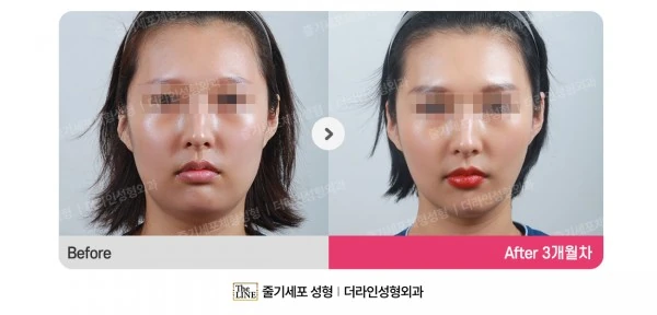 Power V Facial Contouring, before and after 3 months at Seoul Lipo Center