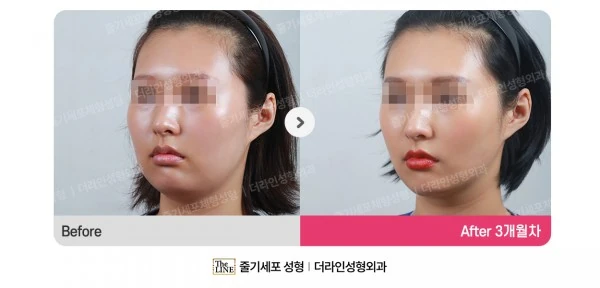 Power V Facial Contouring before-and-after photo, before surgery - TheLINE Plastic Surgery