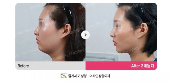 Power V Facial Contouring before-and-after photo, before surgery - TheLINE Plastic Surgery