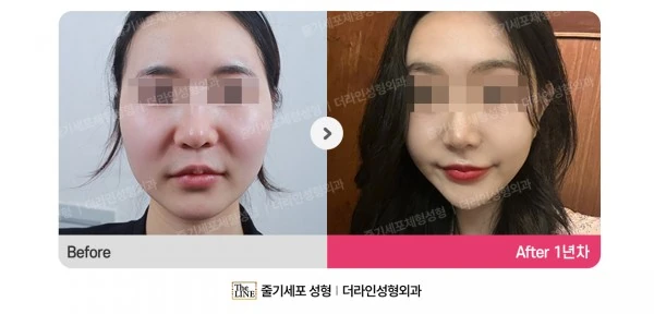 Power V Facial Contouring, before and after 1 year at Seoul Lipo Center