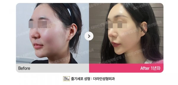 Power V Facial Contouring before-and-after photo, before surgery - TheLINE Plastic Surgery