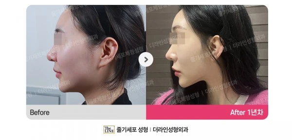 Power V Facial Contouring before-and-after photo, before surgery - TheLINE Plastic Surgery
