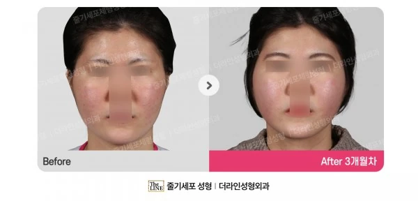 Power V Facial Contouring, before and after 3 months at Seoul Lipo Center
