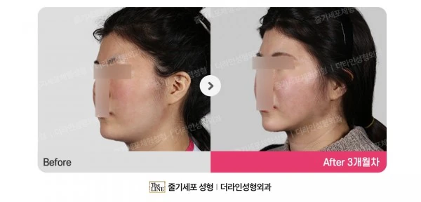 Power V Facial Contouring before-and-after photo, before surgery - TheLINE Plastic Surgery