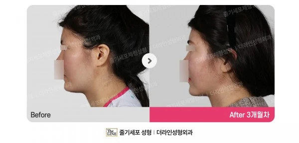 Power V Facial Contouring before-and-after photo, before surgery - TheLINE Plastic Surgery