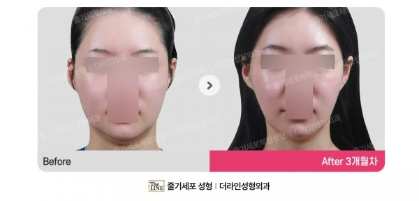 Power V Facial Contouring, before and after 3 months at Seoul Lipo Center