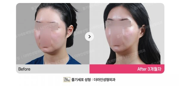 Power V Facial Contouring before-and-after photo, before surgery - TheLINE Plastic Surgery