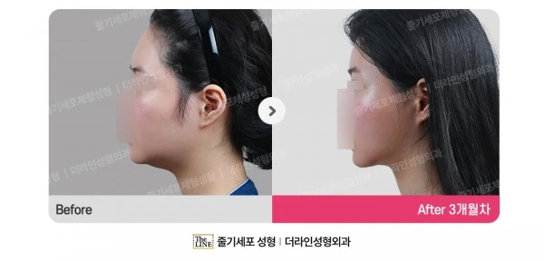 Power V Facial Contouring before-and-after photo, before surgery - TheLINE Plastic Surgery