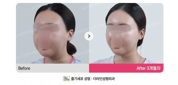 Power V Facial Contouring before-and-after photo, before surgery - TheLINE Plastic Surgery