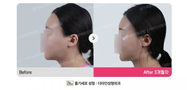 Power V Facial Contouring before-and-after photo, before surgery - TheLINE Plastic Surgery