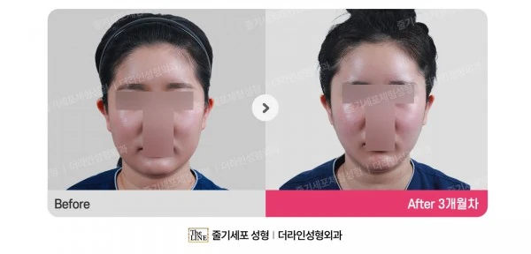 Power V Facial Contouring, before and after 3 months at Seoul Lipo Center