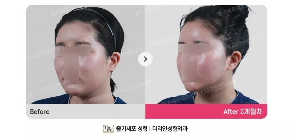 Power V Facial Contouring before-and-after photo, before surgery - TheLINE Plastic Surgery