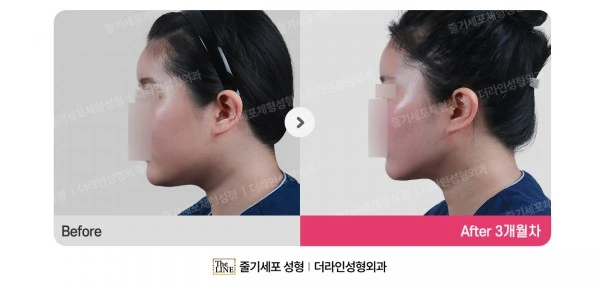 Power V Facial Contouring before-and-after photo, before surgery - TheLINE Plastic Surgery