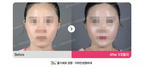 Fat Grafting before-and-after photo, before surgery - TheLINE Plastic Surgery