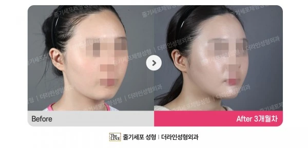 Fat Grafting before-and-after photo, before surgery - TheLINE Plastic Surgery