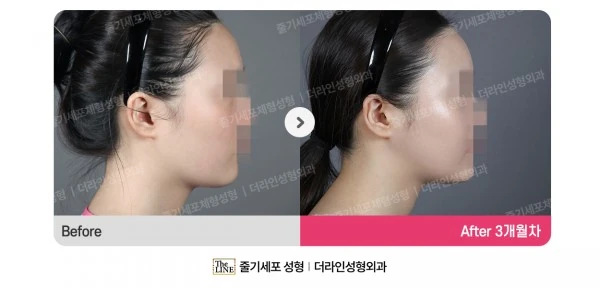 Fat Grafting before-and-after photo, before surgery - TheLINE Plastic Surgery