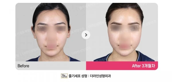 Fat Grafting before-and-after photo, before surgery - TheLINE Plastic Surgery