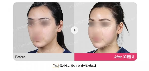 Fat Grafting before-and-after photo, before surgery - TheLINE Plastic Surgery